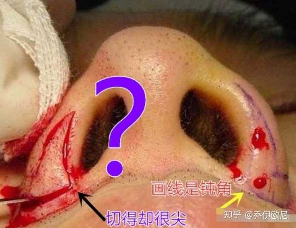缩鼻头鼻翼是什么样的体验?