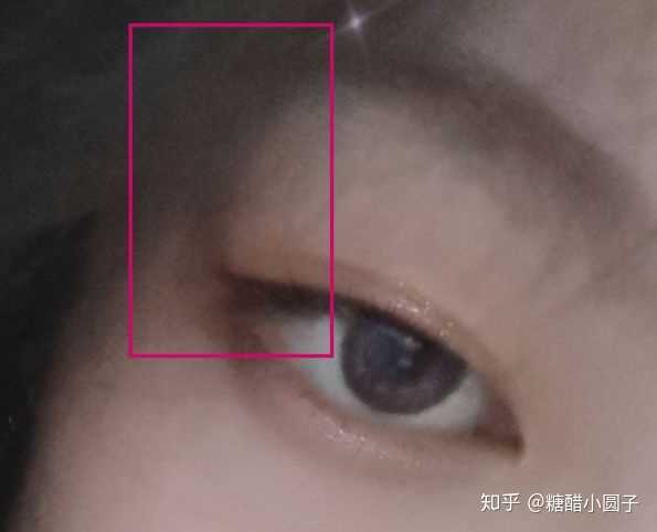 甲亢导致的眼突是不是没救了.