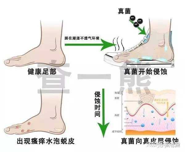 消灭脚部表皮的真菌细菌,但是一般来说,有脚气的人,都是真菌细菌已经