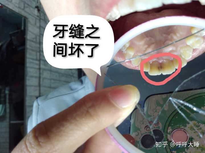 年轻人装烤瓷牙好还是全瓷牙?