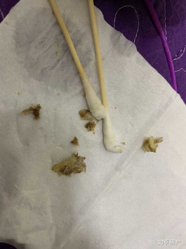 我从小就是感觉耳朵油油的 然后去采耳之后才发现 我的耳屎都是形成