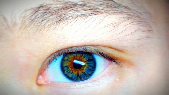 现实中人类异色瞳/虹膜异色症的概率是多少?