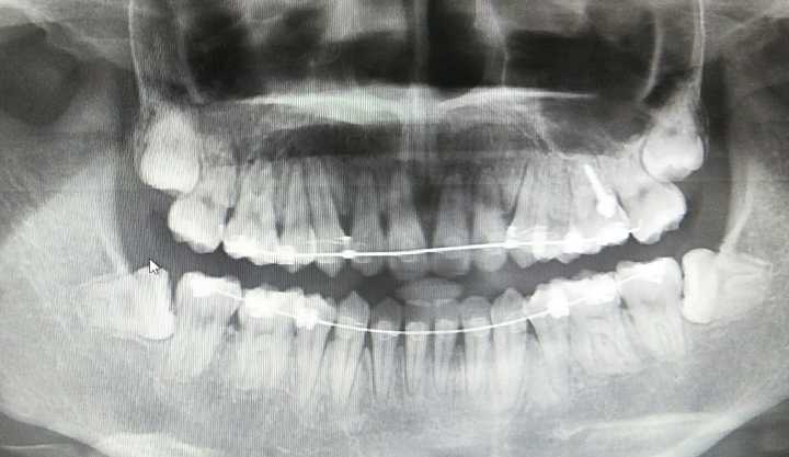 牙根为什么是歪的呢不都是笔直的吗