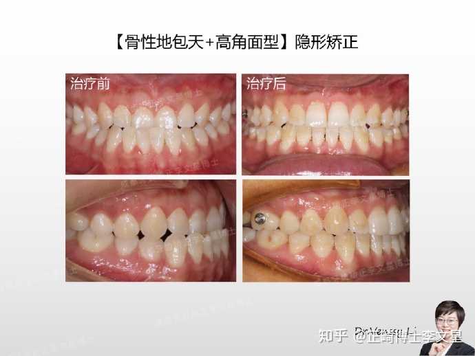 『牙齿拥挤 上牙前突』不拔牙正畸案例