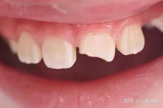 牙齿摔断了一块应该怎样处理?