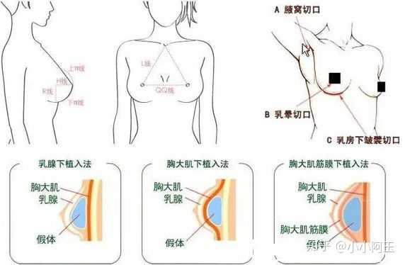 女子隆胸有没有危害?