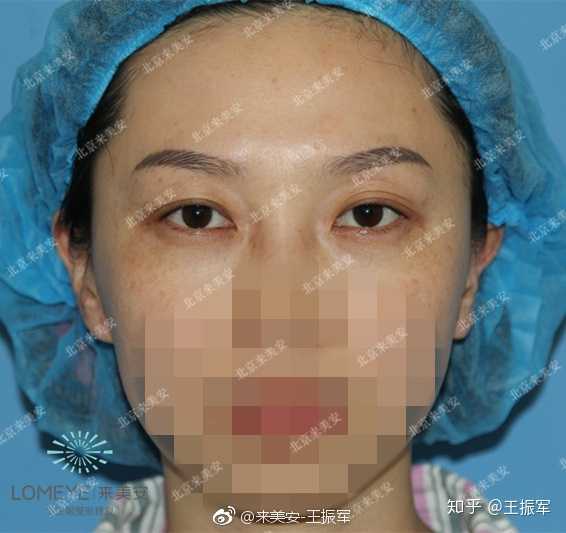 双眼皮修复