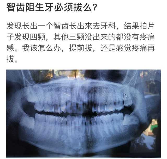 智齿阻生牙必须拔么?