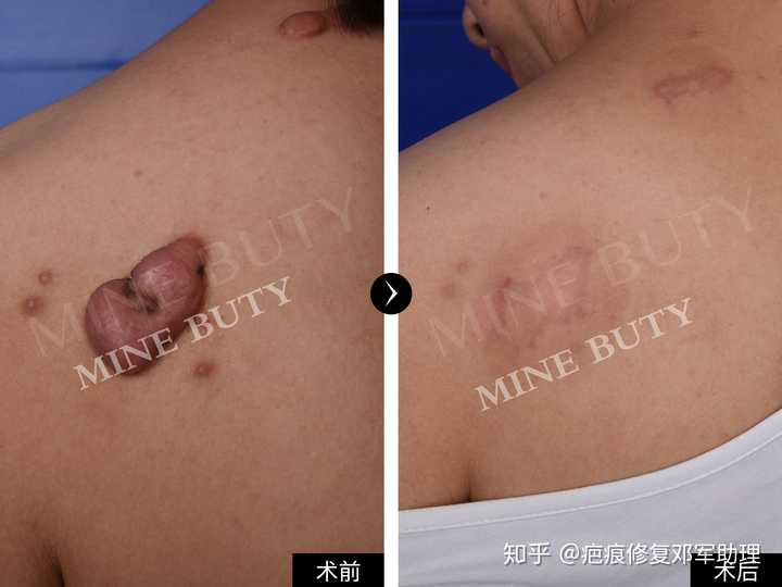 疤痕体质如何有效阻止疤痕变大?