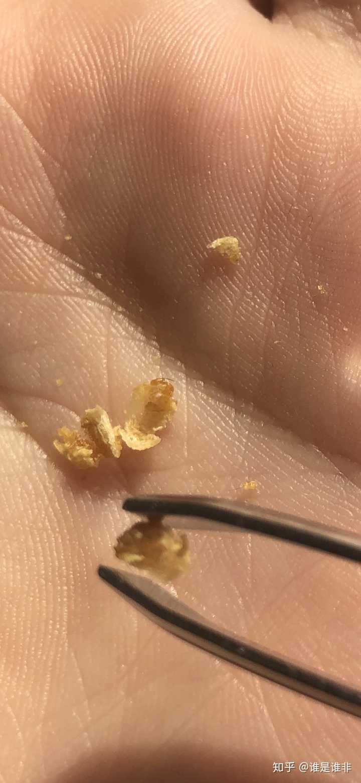另一只耳朵的耳屎有点靠内,被推进去了不敢动,只能等几个月了.