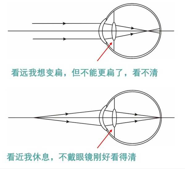 近视眼将来不用戴老花眼镜吗