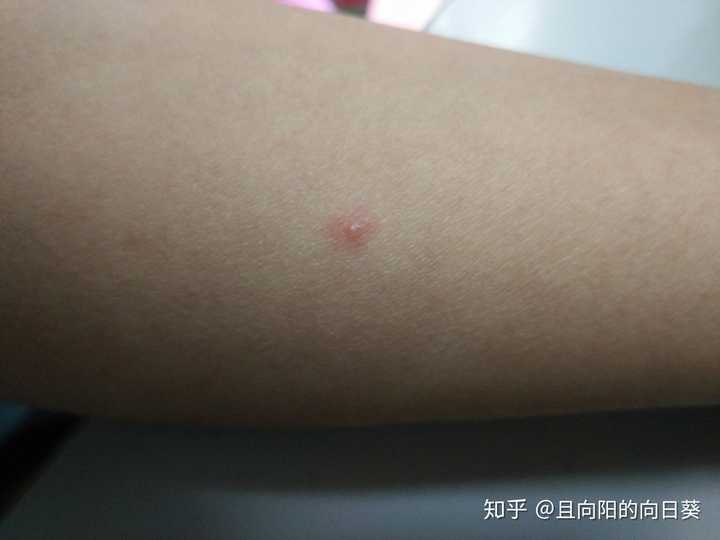 成人长水痘是什么样的经历