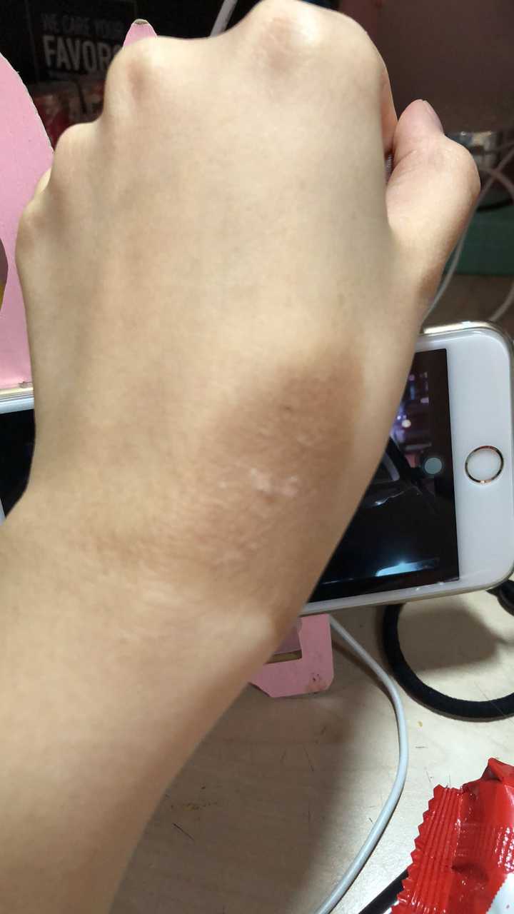 烫伤前后皮肤的具体变化是怎样的?