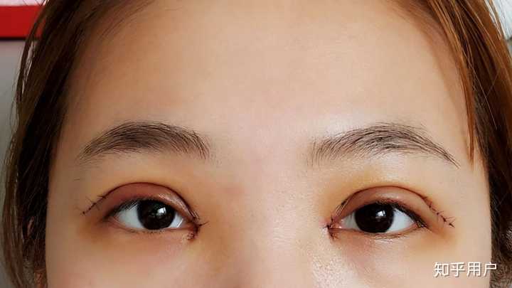 割眼皮 知乎