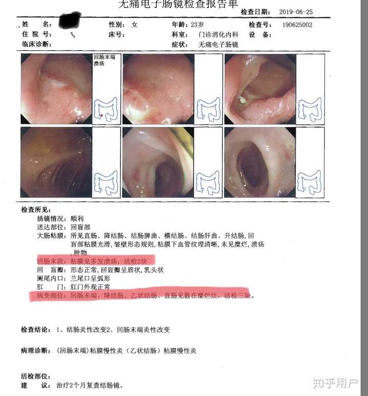 做了两次肠镜,医生疑似克罗恩病,今年才23岁,该怎么对待这件事?