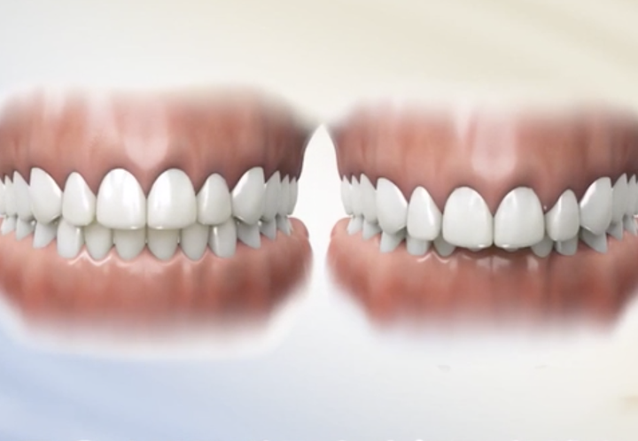 而正常的牙齿咬合是上前牙盖过下前牙的距离不超过下前牙牙冠长度的1