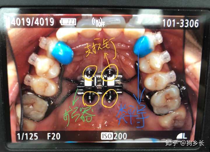 正畸的意义大吗?