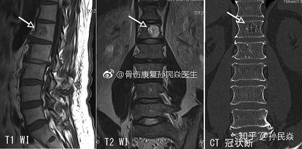 椎体血管瘤 英文vertebral hemangioma 日文:脊椎血管肿