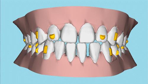 牙齿矫正黑三角跟矫正医生技术有关吗?