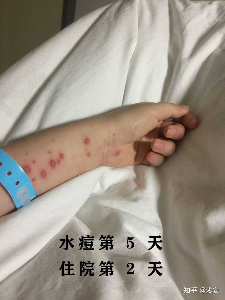 成人长水痘是什么样的经历?