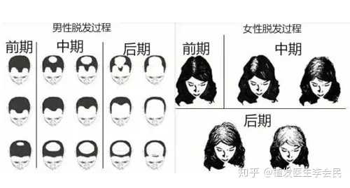 男性脂溢性脱发的治疗方法
