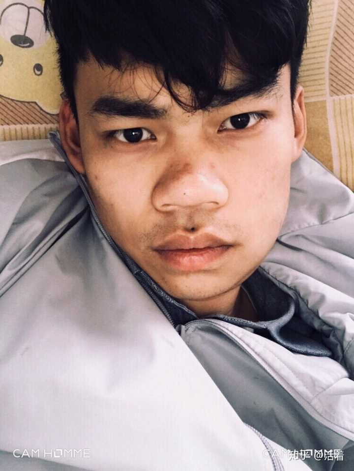 男生矫正牙齿是怎样一种体验?