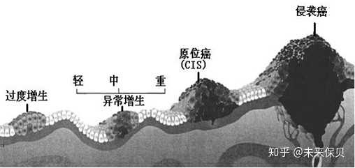 原位癌并不是指某种癌,是指癌症发展中的最早期阶段,比如肺原位癌,胃