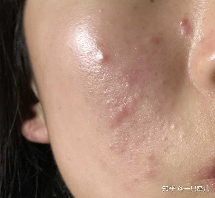 想去针清,做过的人有效果吗?