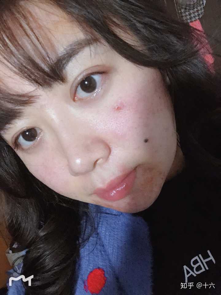 我不想失去我脸上可爱的跟我一起长大的痣好吗!难过!