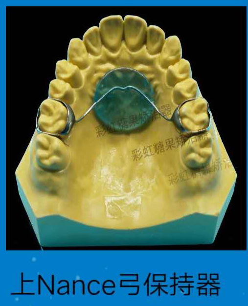 牙齿矫正后一个月,第一次复诊戴上了一个叫nance弓的玩意,感觉满口都