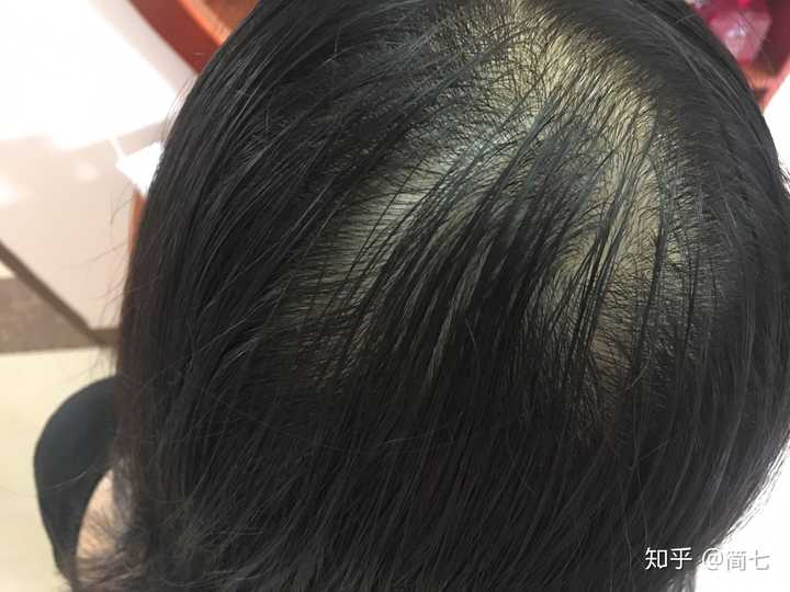 女生22三年前发现头发越来越少头发细软少医院医生说是脂溢性脱发吃了