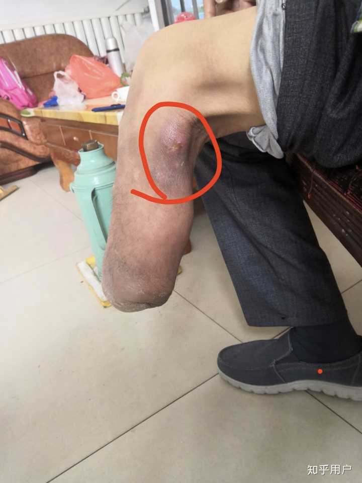 接受腔把腓骨小头给磨破了