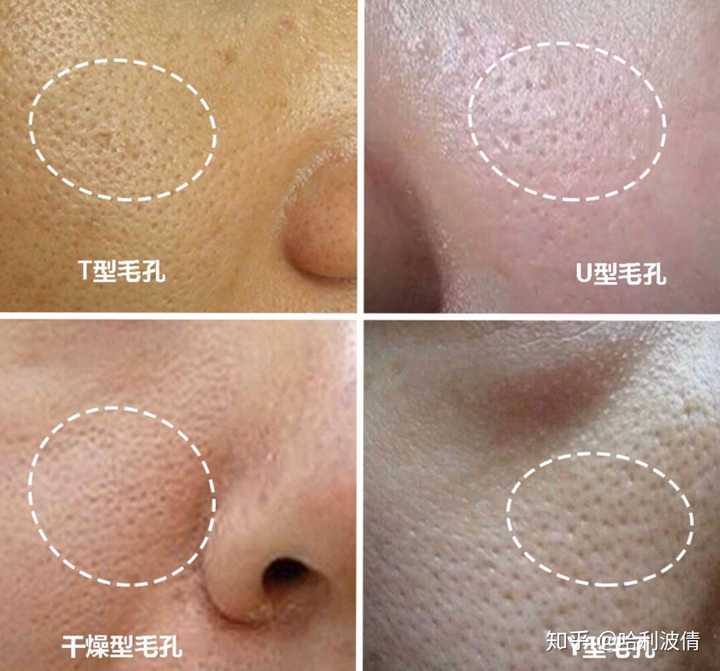 u型毛孔是典型的出油型毛孔,这类毛孔主要表现在油脂旺盛的青少年