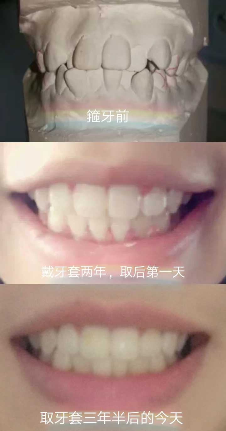 而是和个人牙齿矫正的难度,牙套的类型有关