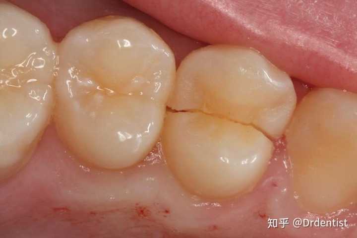 牙医怎么发现患者牙隐裂的?