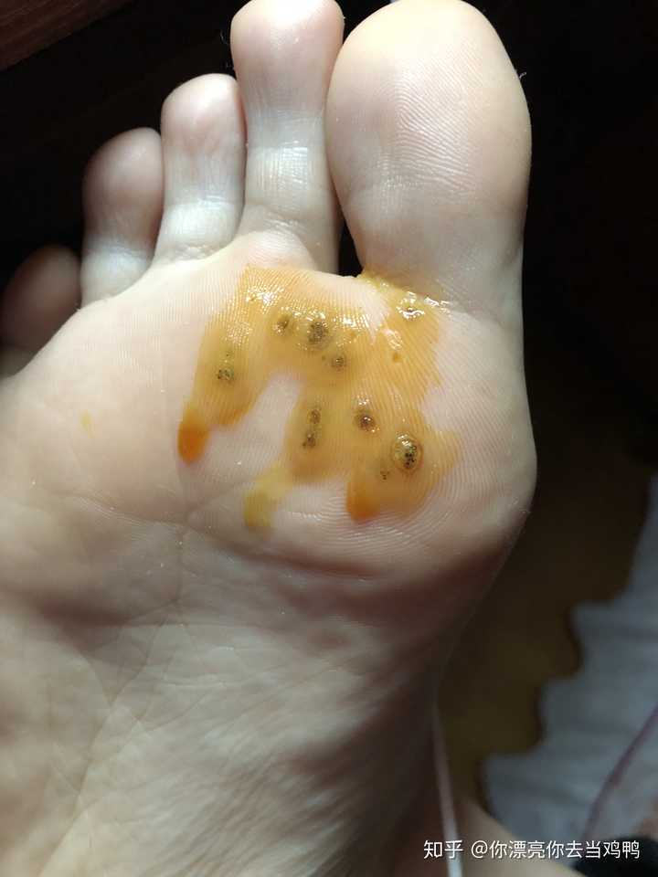 跖疣怎么治