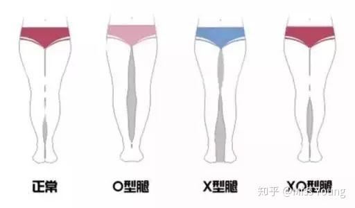 如何后天矫正不漂亮的腿型?