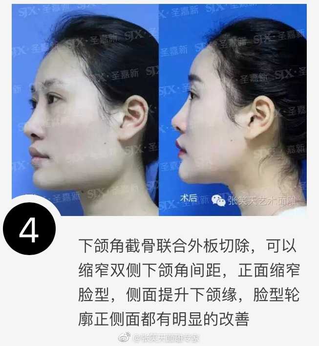 下颌角长曲线截骨的 "6" 大优势,存在… - 知乎