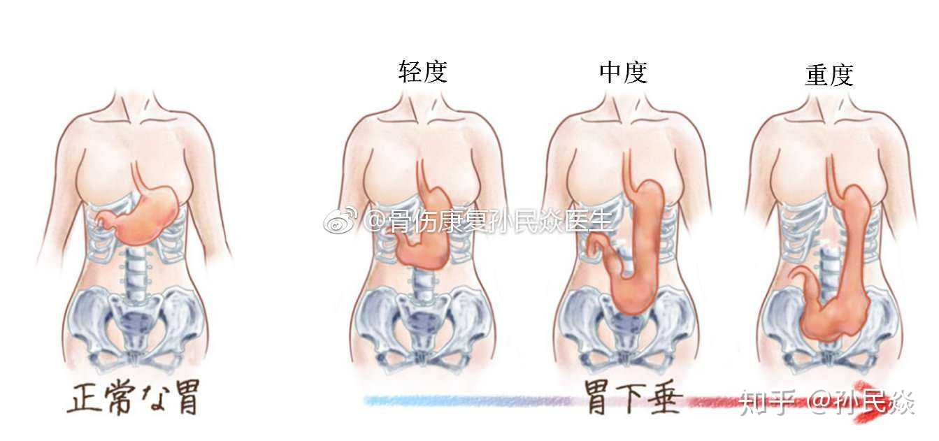 胃下垂 gastroptosis 日文与中文一样,也叫胃下垂.