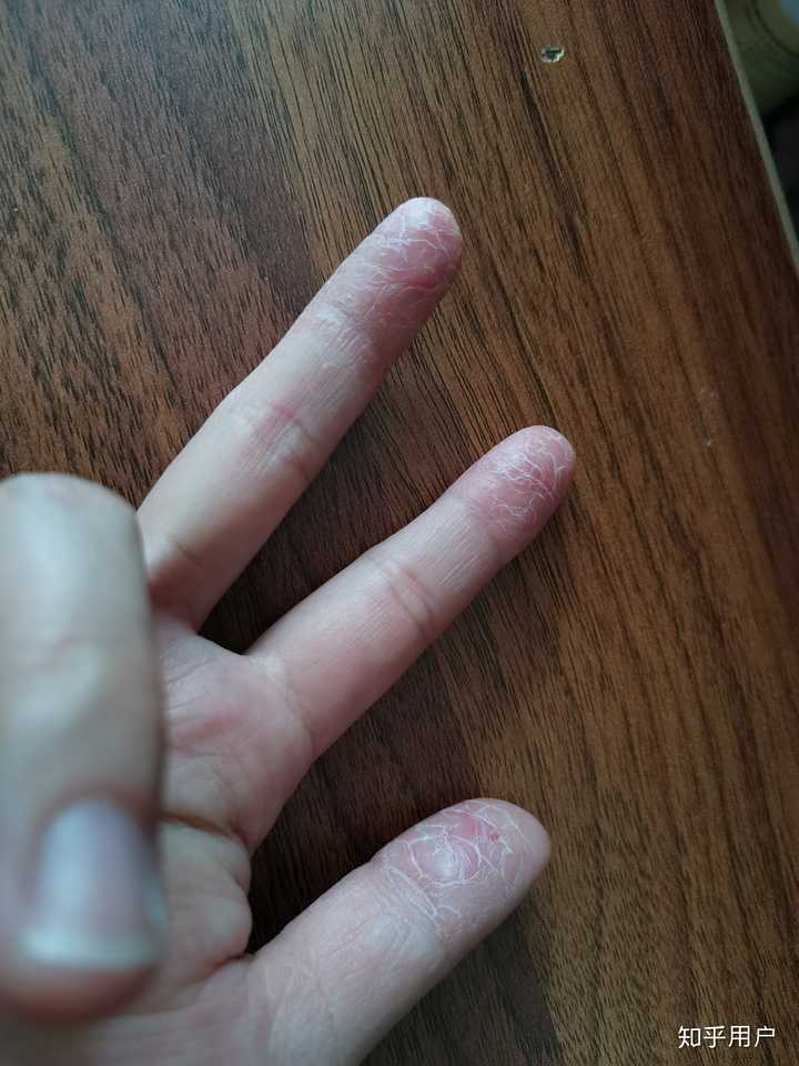 手指起皮,单个手指,干裂,不痒,化验过,不是真菌感染,请问怎么治疗?