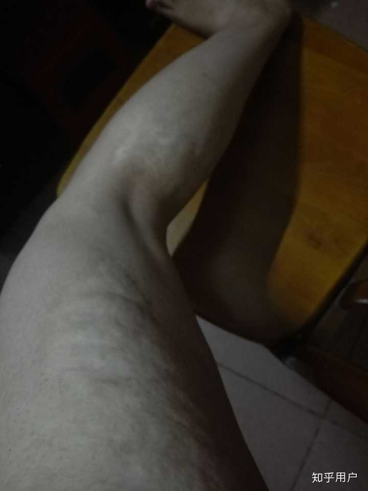 人们看到一个腿上有烫伤疤痕的女孩会怎么想呢?