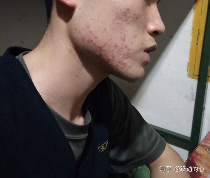 男生如何对付青春痘?