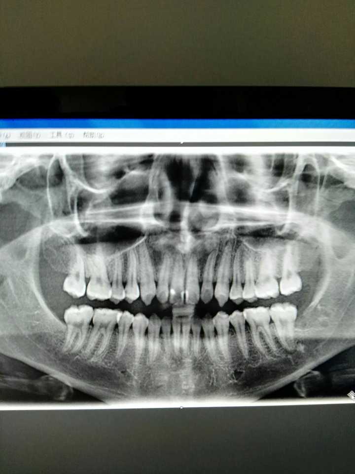 戴牙套带来的容貌的大改观是怎样的体验?