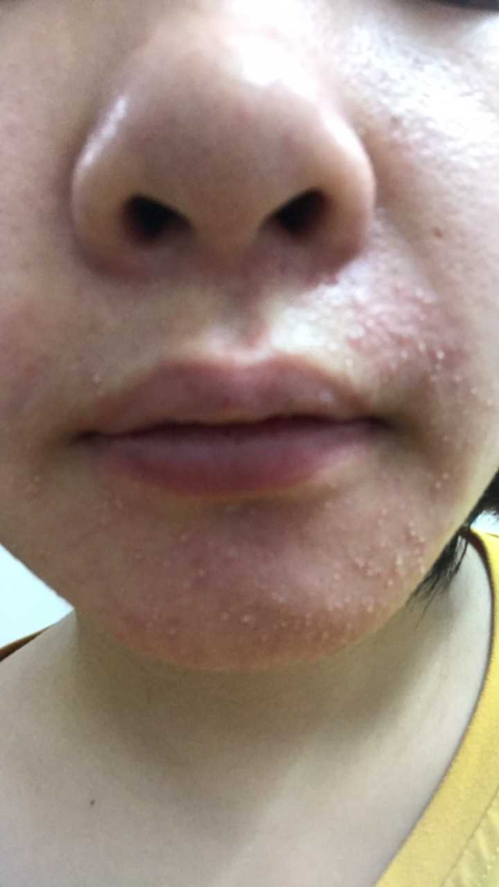 嘴巴周围长一圈白色的点点!每次风和日丽不戴口罩出门就会这样子 ?