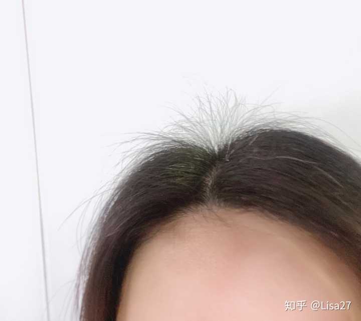 好好睡觉 不熬夜 能让头发长回来吗?