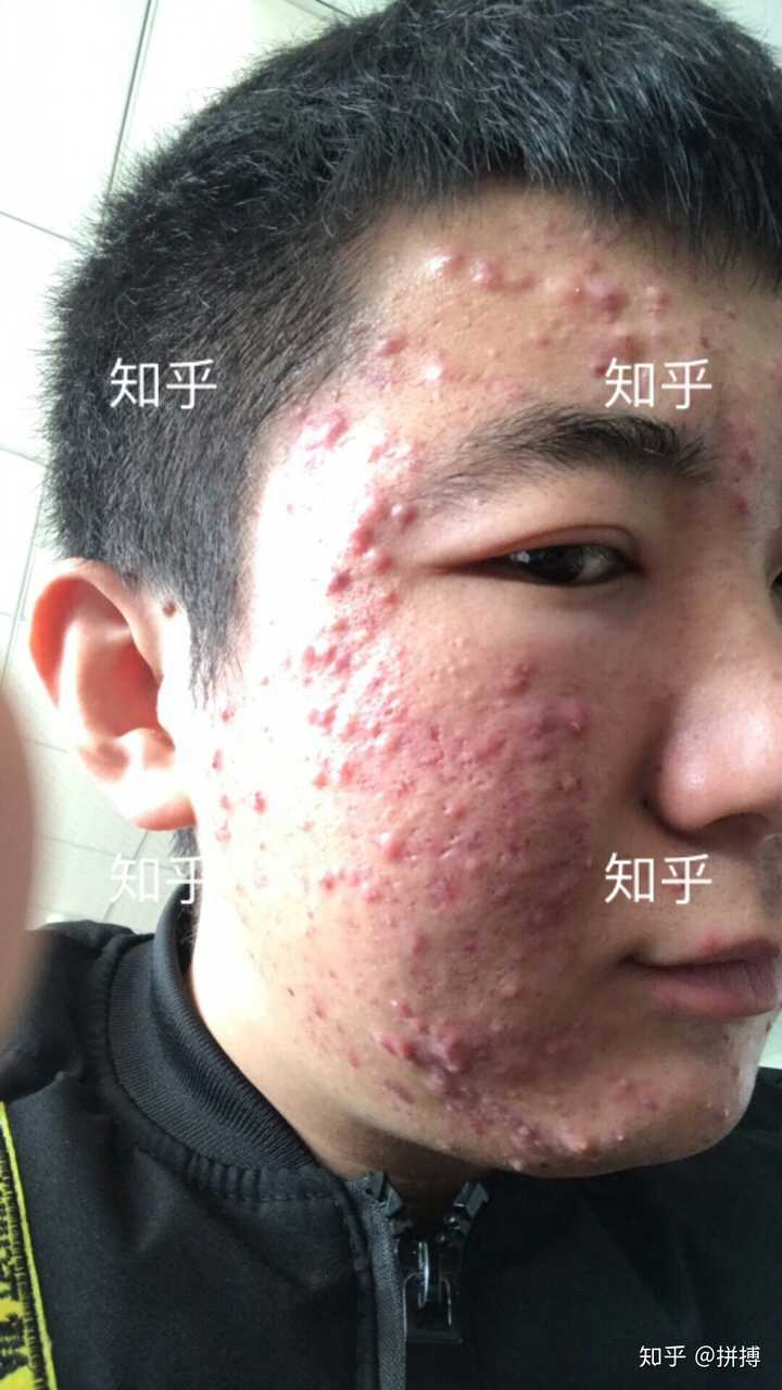 脸上长痘,青春期有必要治吗?