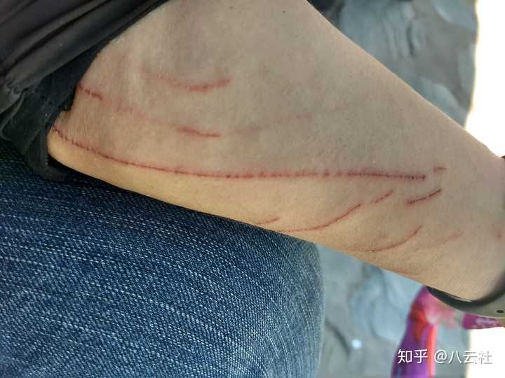 如何区分猫抓和划伤