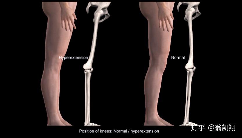 膝盖位置:膝超伸/正常