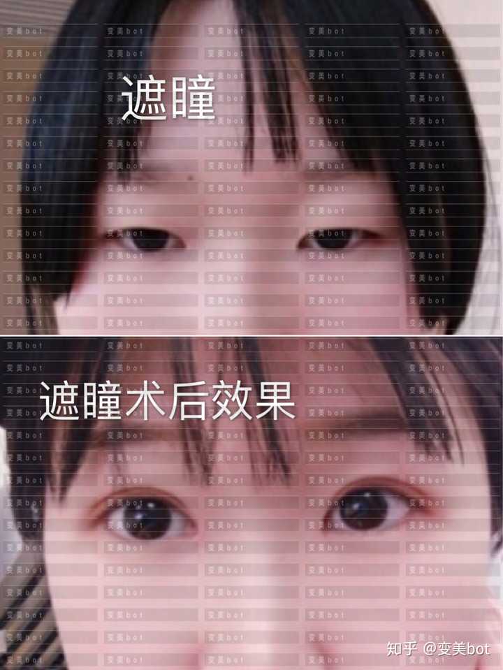 2.金鱼眼