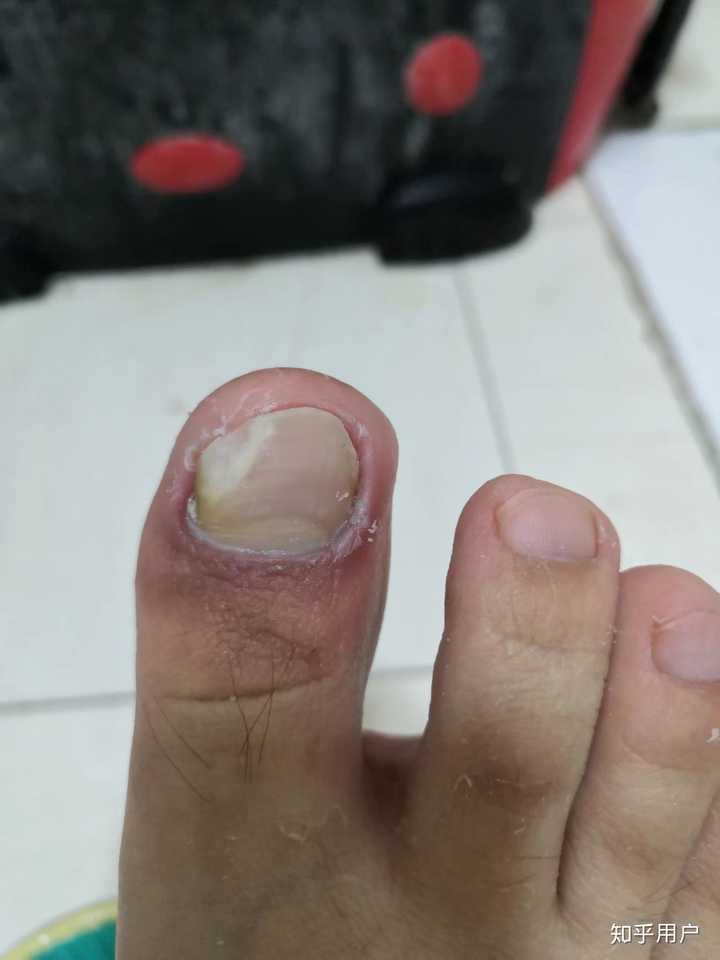 灰指甲可以不用药物治疗吗?电视上说的"亮甲"有效吗?